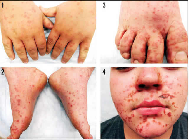 Hand Foot And Mouth Disease For Adults